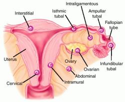 Extrauterniine tehotenstvo - miesta implantacie